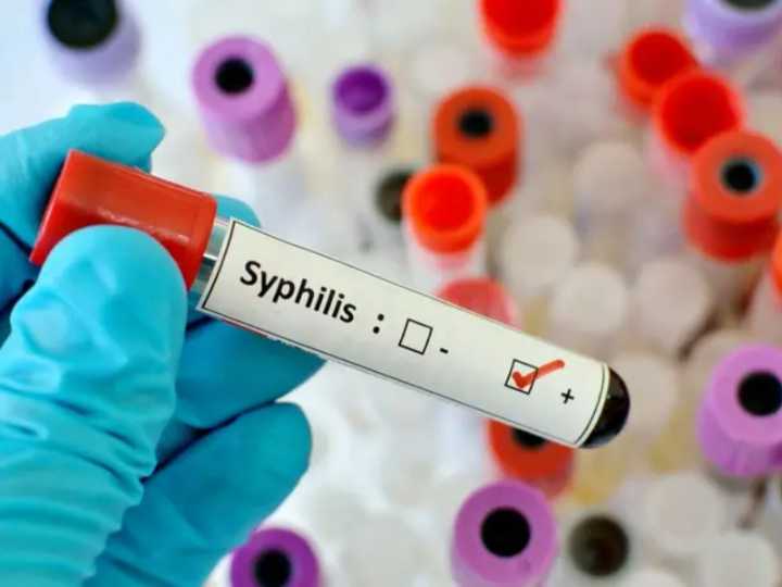 Sífilis en ascenso: alerta por el aumento de casos y la revelación sobre las edades afectadas