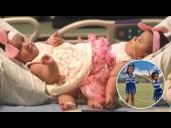 Formerly conjoined twin sisters defy the odds