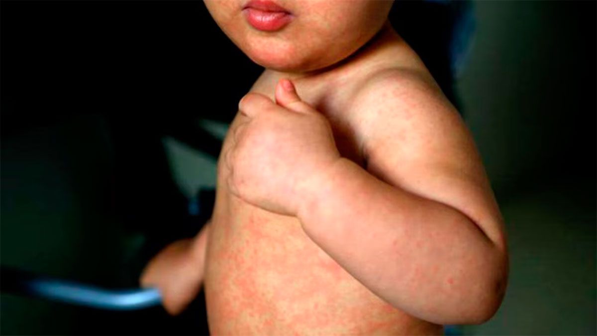 Más de 5.000 casos de sarampión en Canadá en medio de un descenso en la vacunación infantil