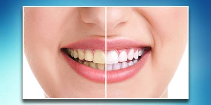 Usa esta poderosa mezcla para blanquear tus dientes de manera segura