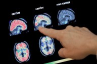 Opinion: We need an urgent response to the coming Alzheimer’s crisis