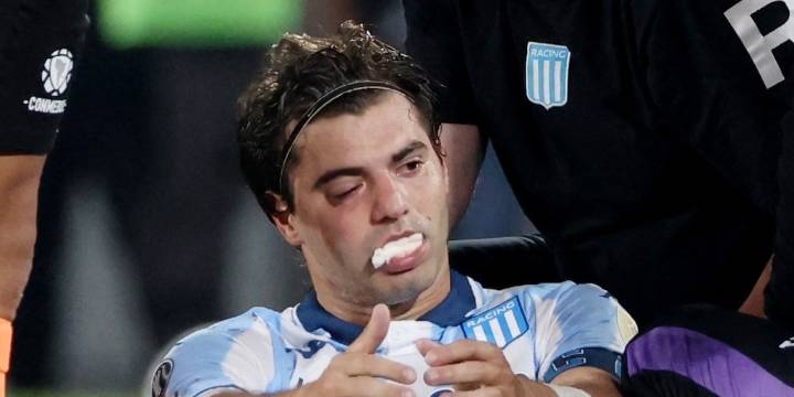 Santiago Sosa mostró cómo quedó su rostro tras la operación por la fractura que sufrió por un golpe de Marcos Rojo