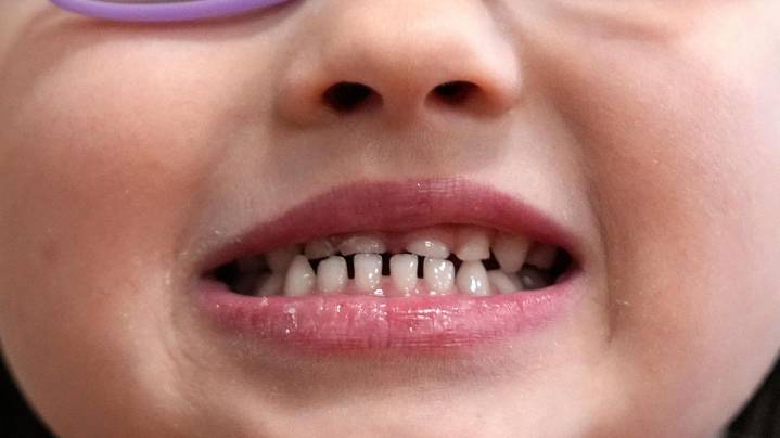 FDA restricts use of kids' fluoride supplements citing emerging health risks