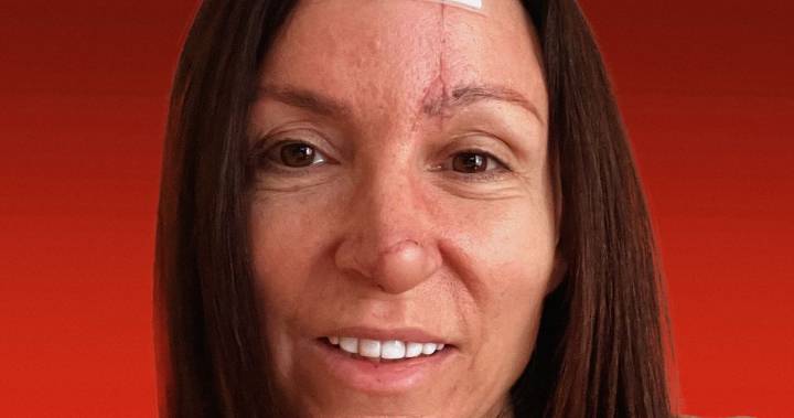 My Journey After Losing My Nose to a Dog Bite