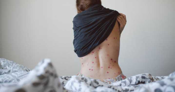 Aumentan los casos de varicela en Quintana Roo: ¿Qué es, cómo se manifiesta y cómo prevenirla?