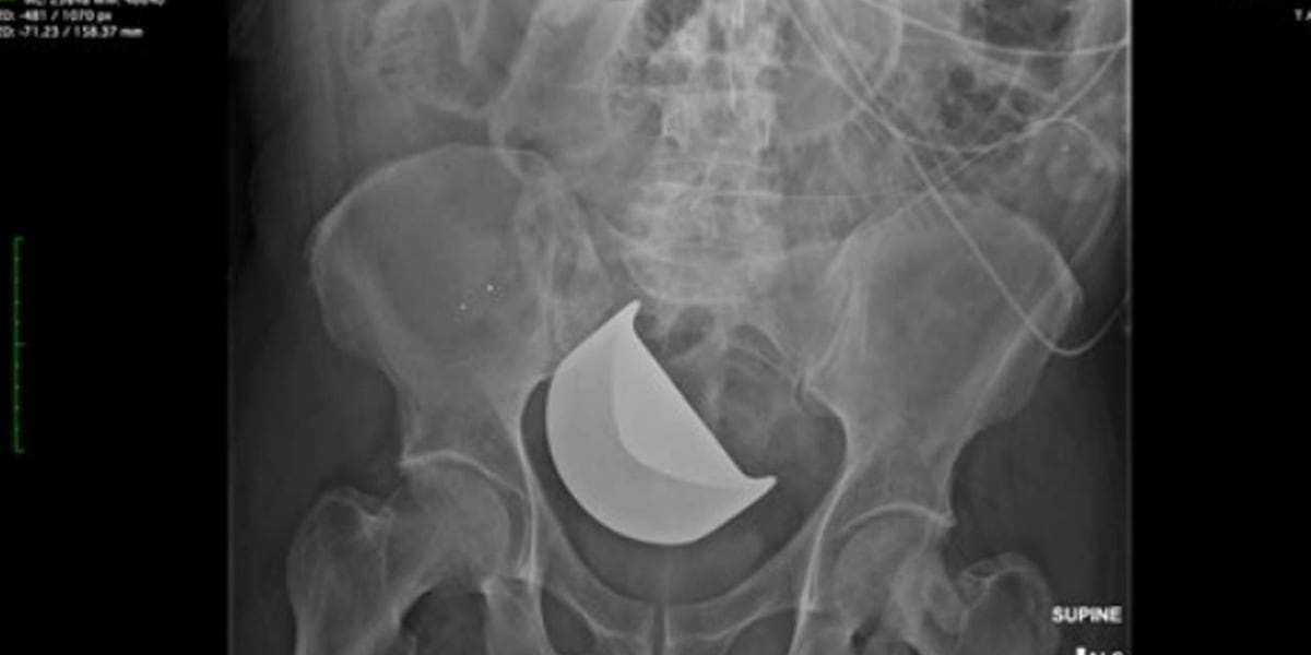 State pays $1 million after man dies from MUSC blade left in body