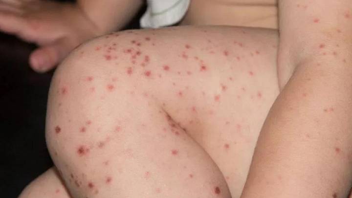 Alerta en Salta por cuatro viajeros con sarampión que pasaron por la provincia