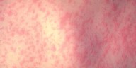 Measles case confirmed in Nashville, first in city in 20 years
