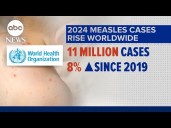 ​Measles surge sparks global concern