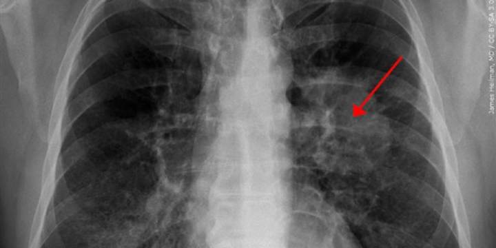 November is Lung Cancer Awareness Month