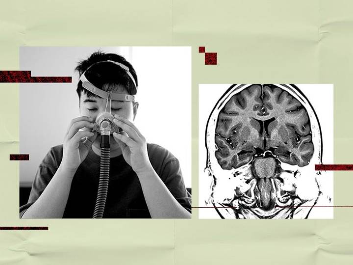 Could treating obstructive sleep apnea lower stroke or dementia risk?