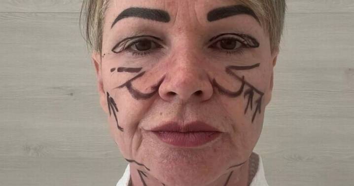 Botched £7k facelift leaves Ayrshire woman with 'lopsided mouth' after travelling to Lithuania