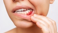 Dentists reveal the worst foods for gum inflammation 
