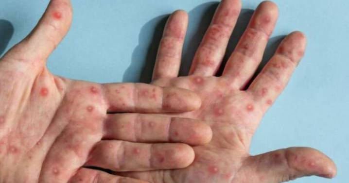 Sarampión en México 2025: confirman 23 defunciones asociadas al virus