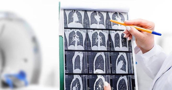 Under Current Guidelines, Most Lung Cancer Patients Weren't Eligible for Cancer Screening