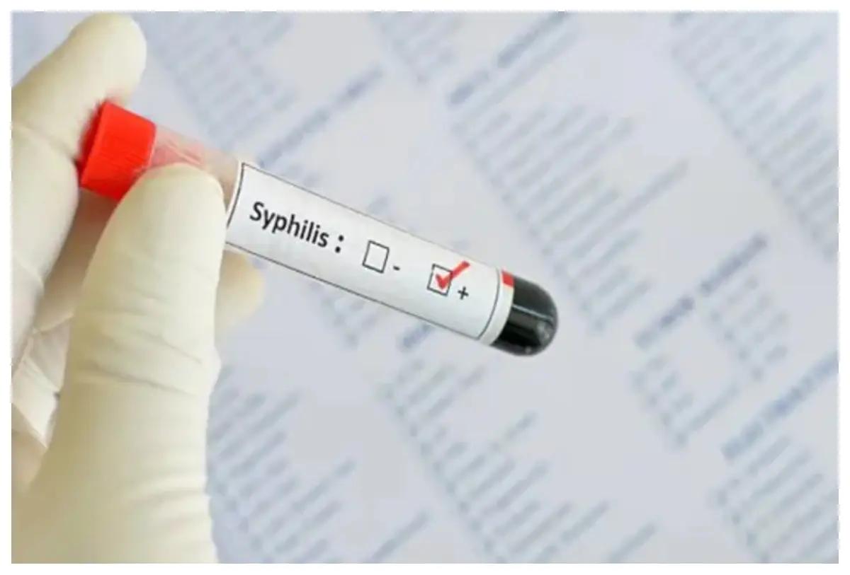 Jalisco lidera el repunte de sífilis en México; aumentan 17.5% los casos nacionales