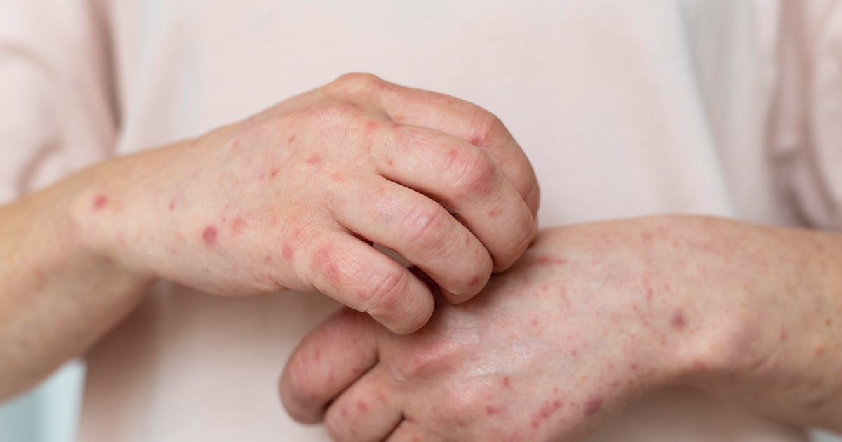 Canadá deja de ser un país libre de sarampión tras un brote que deja más de 5 mil casos