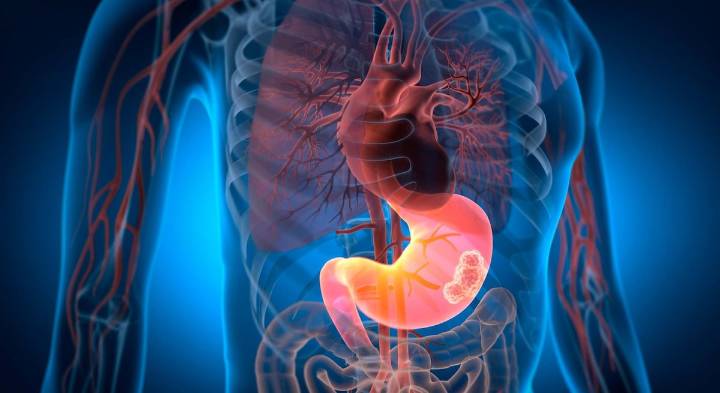 70% de mexicanos aloja bacteria relacionada con cáncer gástrico, informa la AMG