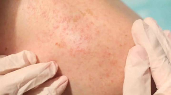 México enfrenta riesgo de perder certificación libre de sarampión, advierte OPS