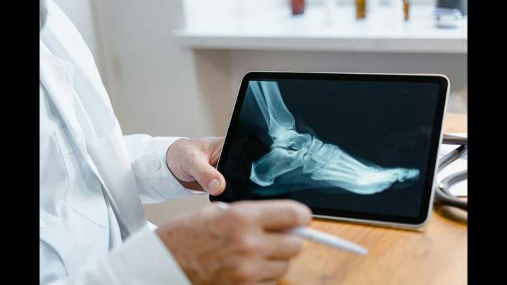 Are Microplastics The New Hidden Threat To Bone Strength? Experts Weigh In