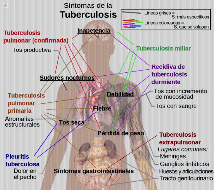 La tuberculosis es curable