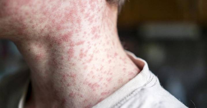 Measles cases confirmed at N.O. airport; health expert points to immunization decrease