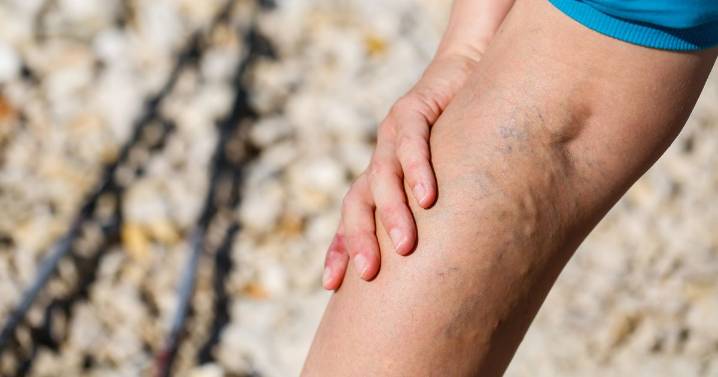 Symptom impacting legs could be sign of 'silent killer'