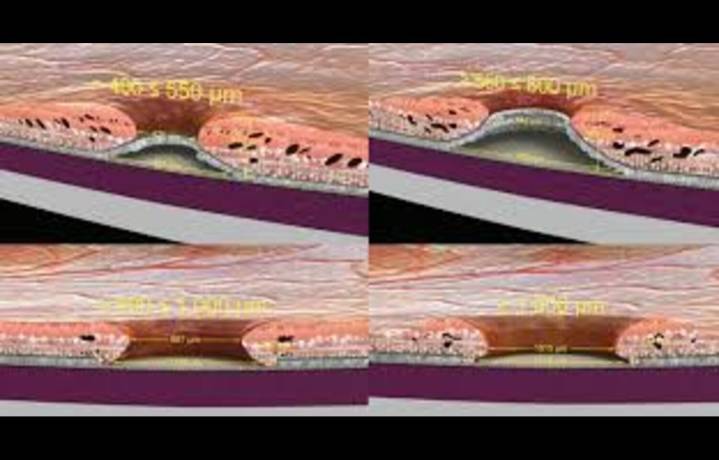 Dyslipidemia Linked to Delayed Macular Hole Closure After Surgery: Study