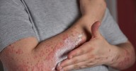 Su piel es tan delicada como una mariposa: conozca la epidermólisis bullosa y lo que sufren los pacientes