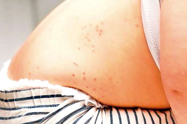 Primer caso de sarampión en la entidad