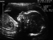 Late-term abortions are happening in Canada without a medical reason