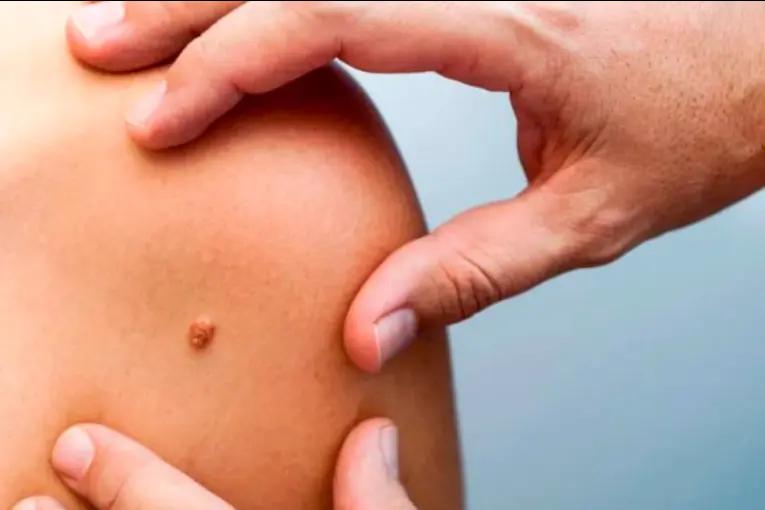 Cáncer de piel: habilitan en el país la vacuna para tratar melanoma de alto riesgo