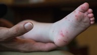 Hand, foot and mouth disease cases on the rise in the Commonwealth