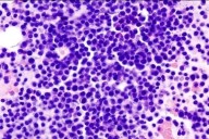 Autorizan un nuevo tratamiento que mejora la respuesta en pacientes con mieloma múltiple