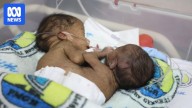 Australian doctors visit rare PNG conjoined twins to assess options