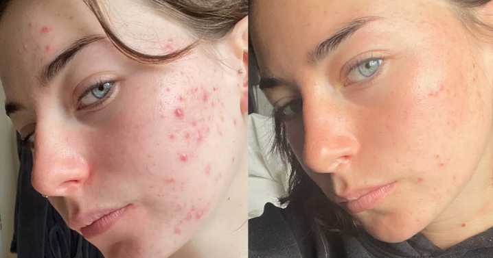 Award-winning serum bringing 'hope' back to bad skin sufferers now £24
