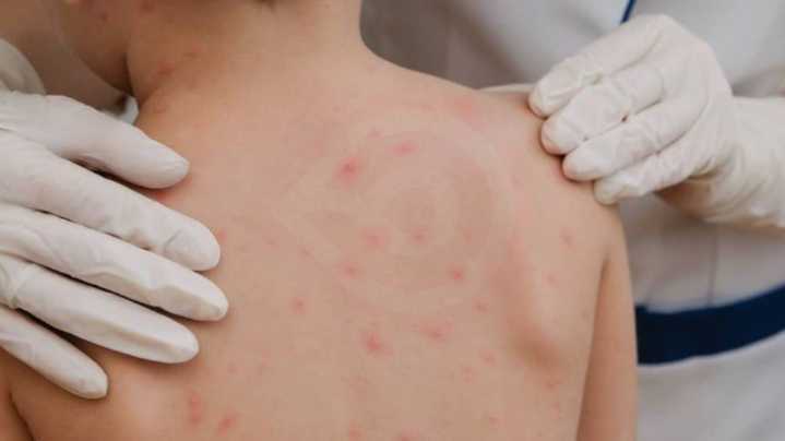 La Secretaría de Salud de Hidalgo confirma el primer caso de SARAMPIÓN en la entidad