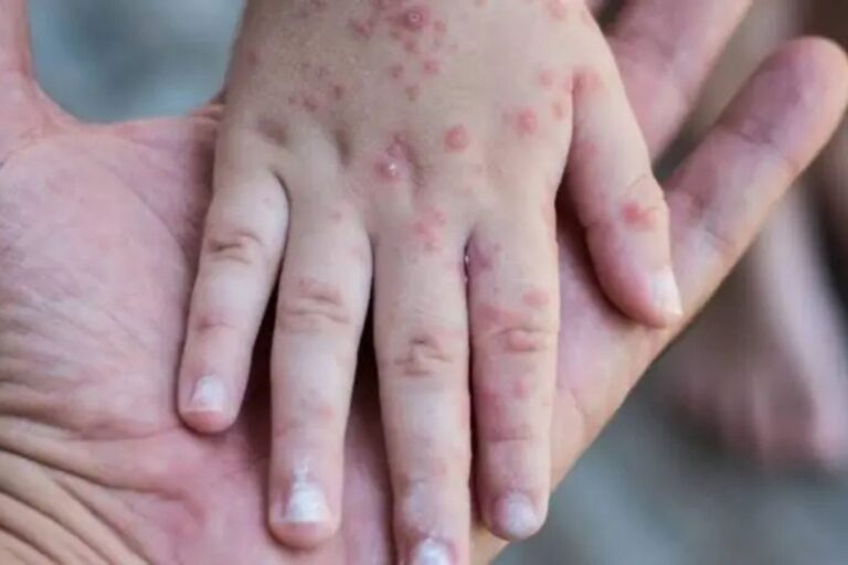 Coxsackie en Hidalgo: Este es el llamado de la SSH ante la presencia del virus