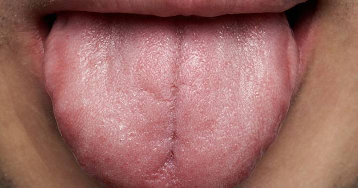 Simple tongue scan may detect early symptoms of a debilitating disease
