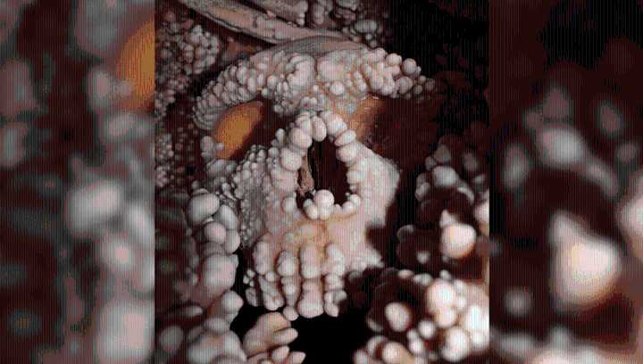 Famous Altamura Neanderthal Remains Reveal First-Ever Preserved Nasal Cavity In Human Fossil Record