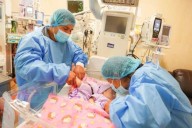 Minsa: pequeñas siamesas prematuras se preparan para futura cirugía de separación