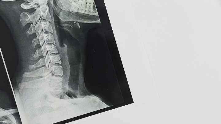 Identifican la célula de origen del sarcoma de Ewing, un tumor pediátrico de gran agresividad