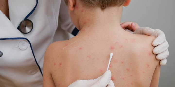 Chile emitió una alerta epidemiológica ante aumento de casos de sarampión en Argentina