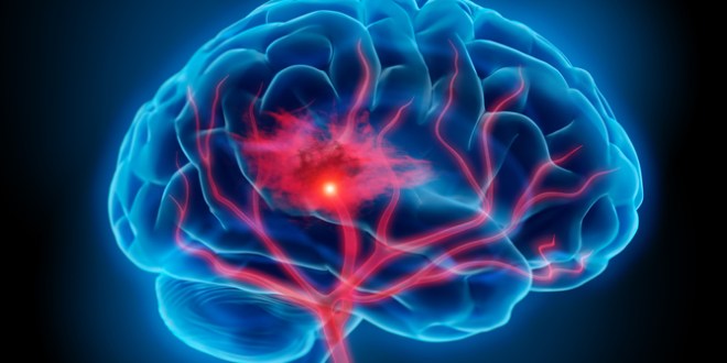 Detectar a tiempo los síntomas del Ictus, fundamental para salvar vidas