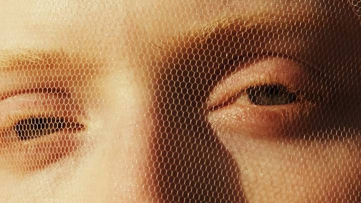 How Safe Is Radiofrequency Microneedling, Really?