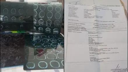 Hospital Almenara: adulta de 70 años con cuatro aneurismas pide ayuda para que la operen