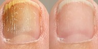 Cómo eliminar hongos en las uñas de los pies o de las manos de forma casera y sin correr riesgo de reinfección