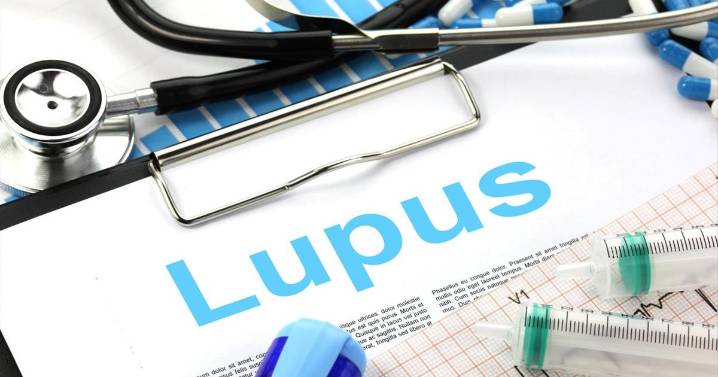 Un estudio de Stanford vincula el lupus a un virus común en casi toda la población