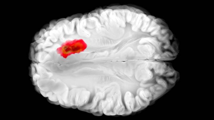 This Common Drug Seems to Fight One of The Deadliest Brain Cancers