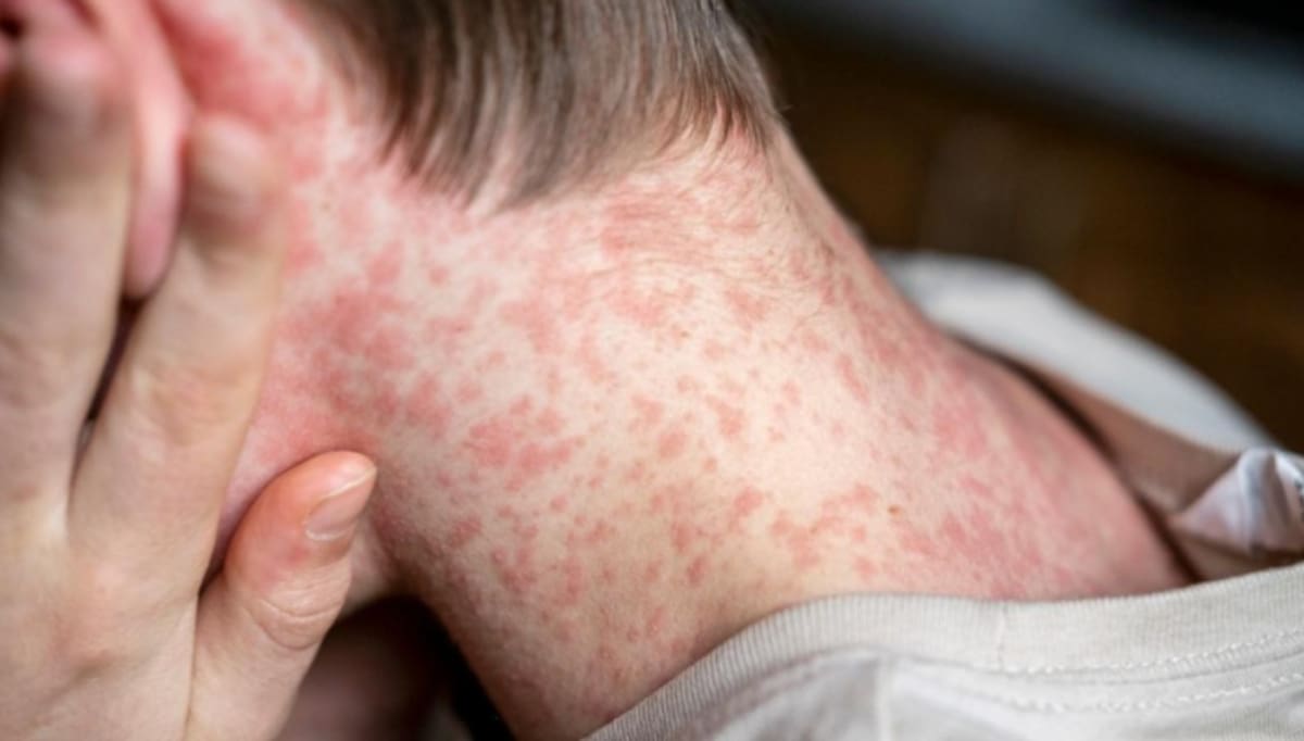 Letal en niños y embarazadas. Un experto analizó el alerta sanitaria por sarampión y reveló “la única manera” para evitar una epidemia en el país